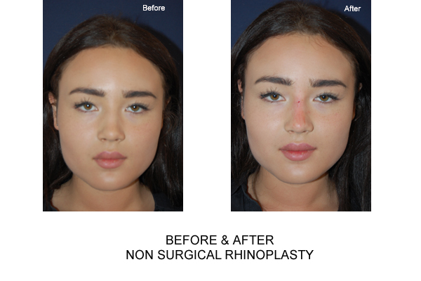 Non Surgical Nose Job / Rhinoplasty in London 111 Harley St.