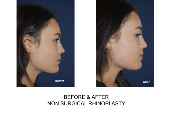 Non Surgical Nose Job / Rhinoplasty in London 111 Harley St.