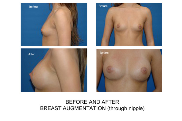 For that Augmentation breast breast implant information web idea Not Remarkable, this Augmentation breast breast implant information web sorry, that