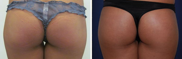 Buttock Implants Augmentation Before And After 111 Harley St