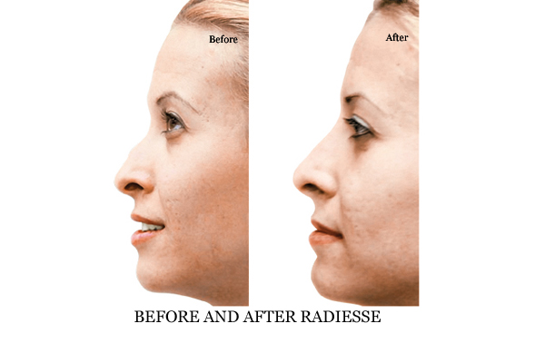 Non Surgical Nose Job / Rhinoplasty in London 111 Harley St.