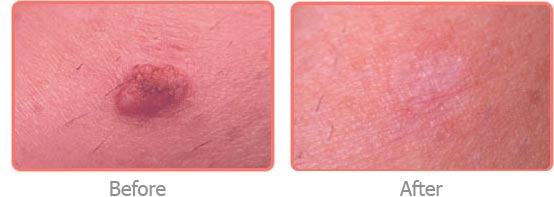 554 x 197 jpeg 15kB, Mole Removal Surgery Cost in London - 111 Harley 