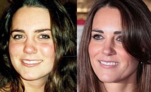 Operaciones de ojeras antes y despues de adelgazar