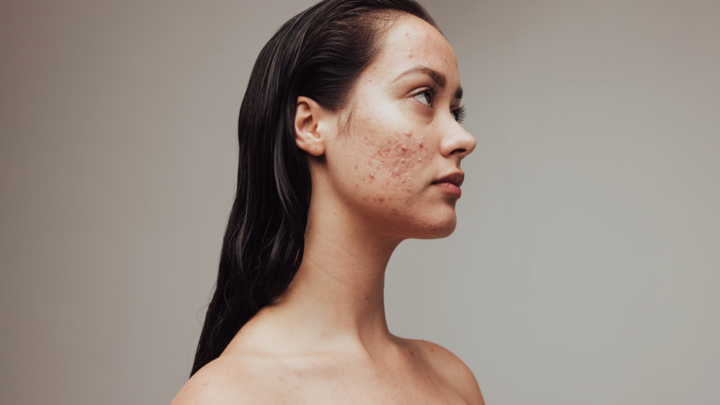Adult Acne