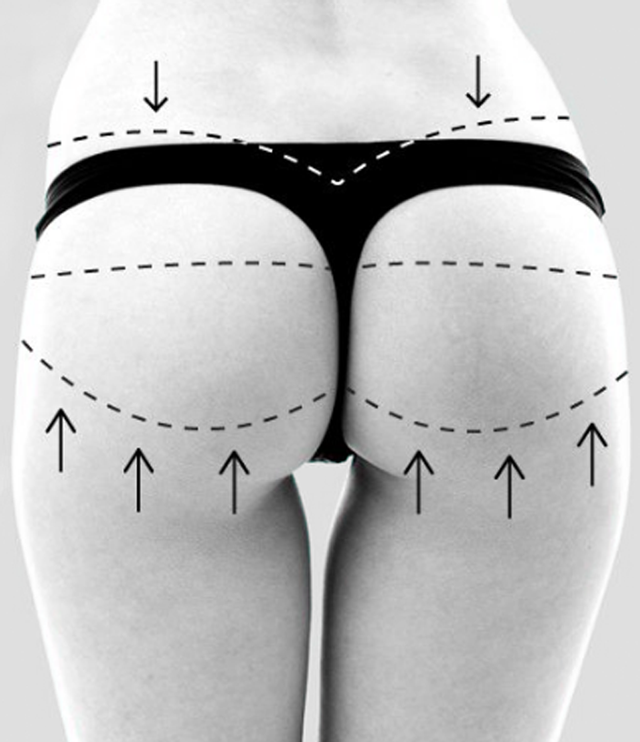 buttock implants surgery London