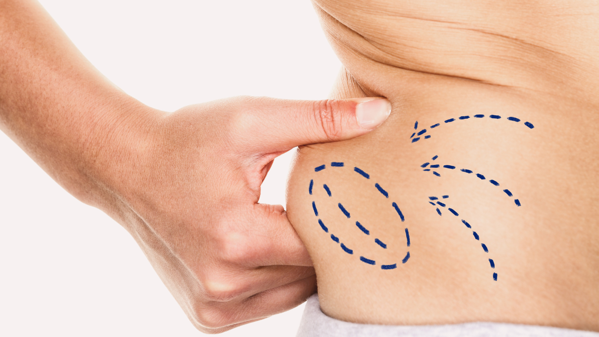 Man holding love handles before Vaser Lipo procedure
