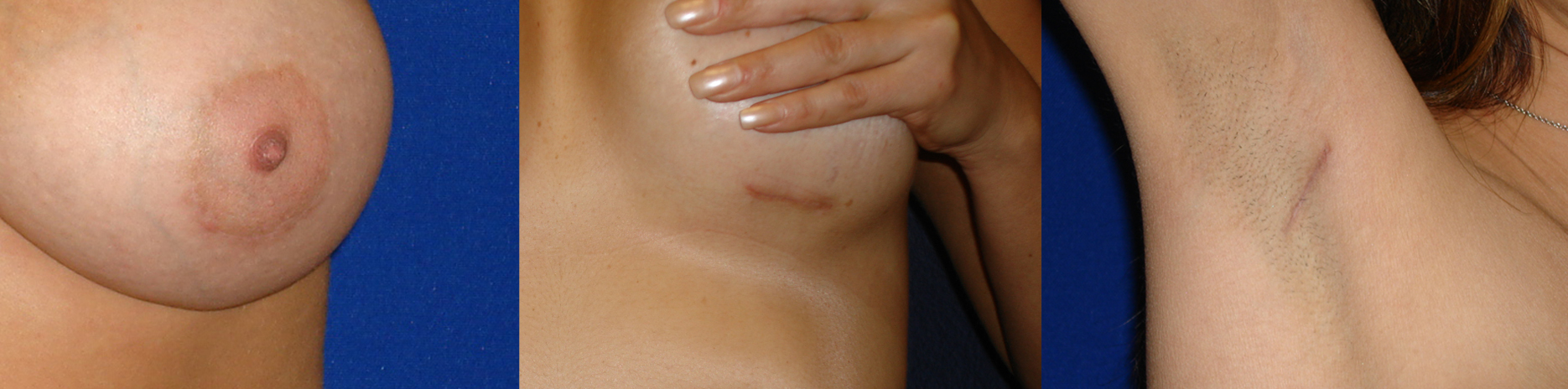 Breast Enlargement Scarring