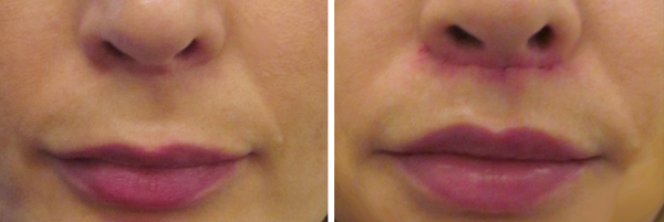 Lip Lift Before & After Photographs - 111 Harley St.