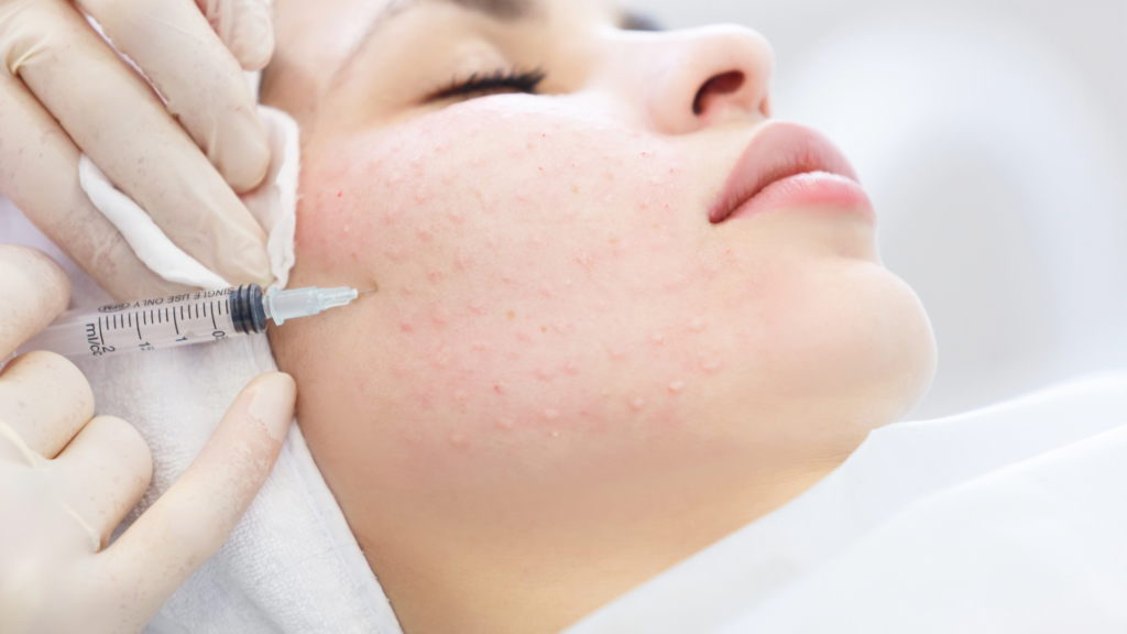 mesotherapy for acne