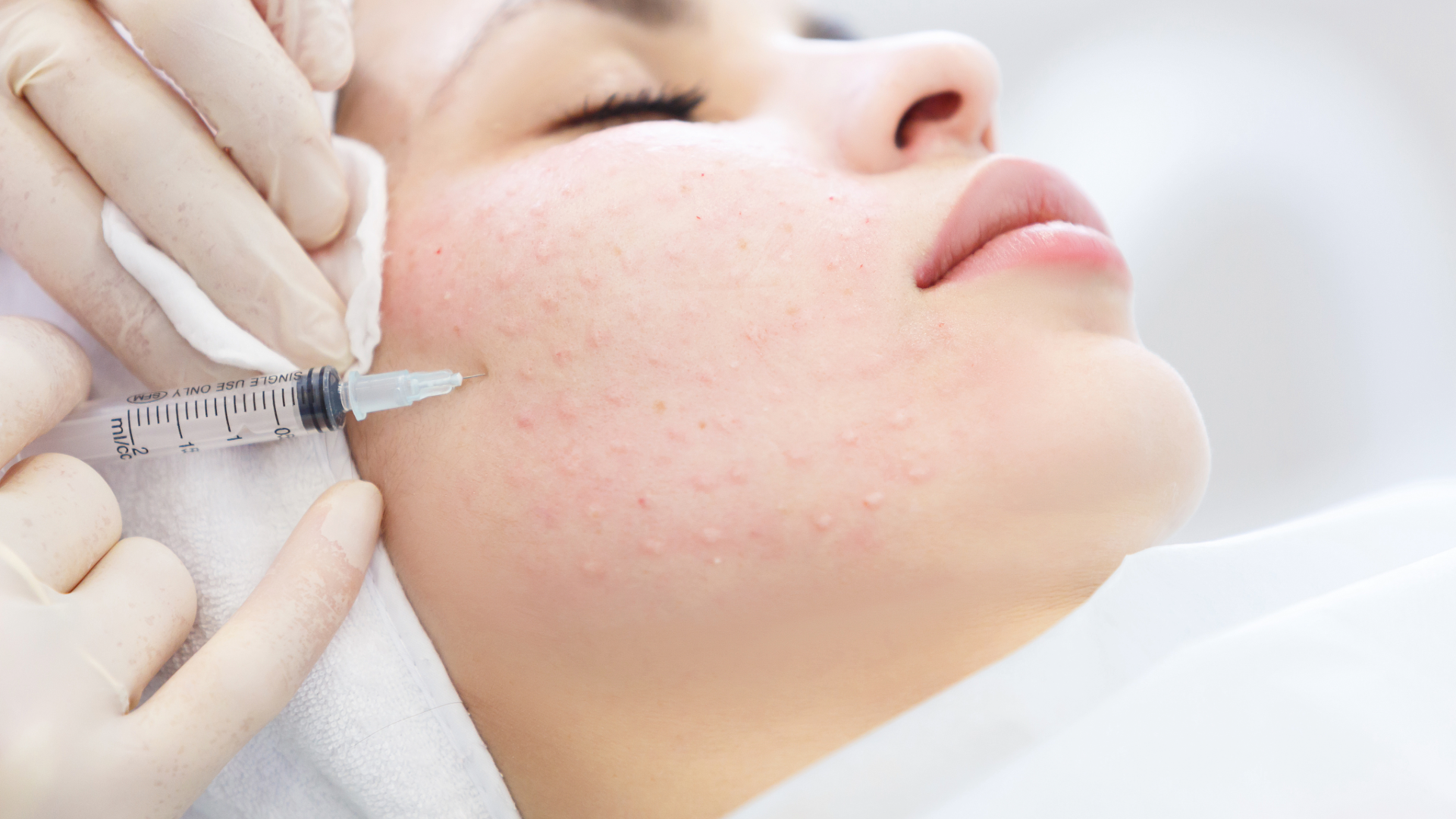 Mesotherapy For Acne Scars