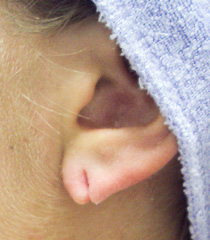 torn earlobe