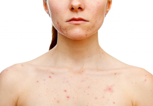 adult acne