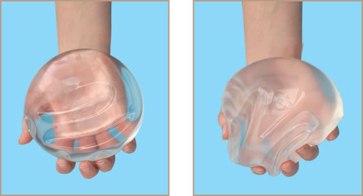 Saline vs silicone breast implants