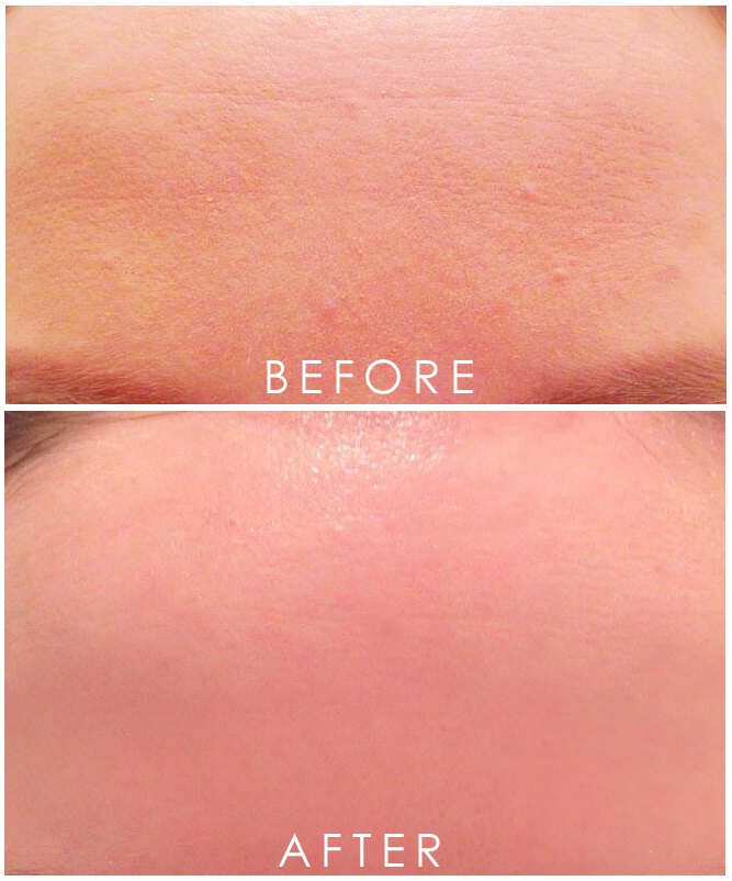 dull skin before and after