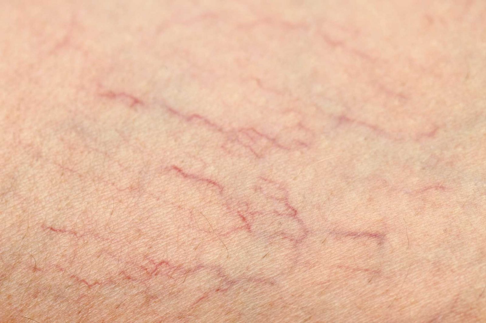 spider veins