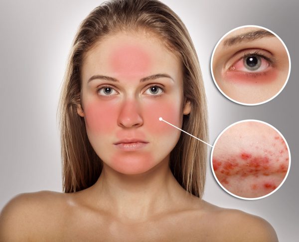 Rosacea diagram