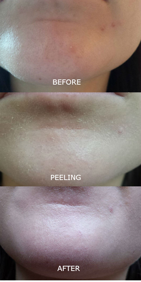 What it’s like to have a Jessner skin peel