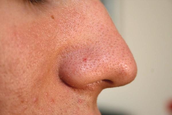 The Best Treatments for Blackheads