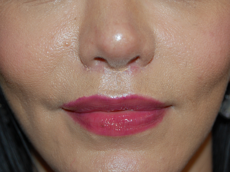 Lip Lift Surgery in London Cost & Results 111 Harley St.