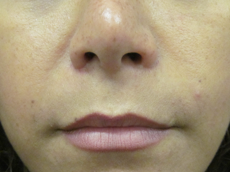 Lip Lift Surgery in London Cost & Results 111 Harley St.