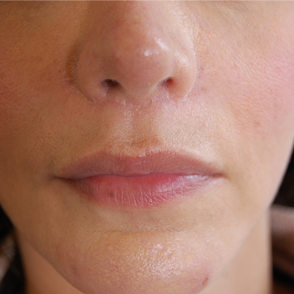 Lip Lift Surgery in London from £3190 111 Harley St.