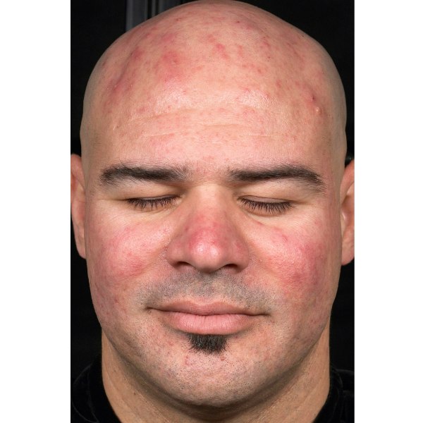 Isolaz Acne Treatment in London Clinic UK 111 Harley St.