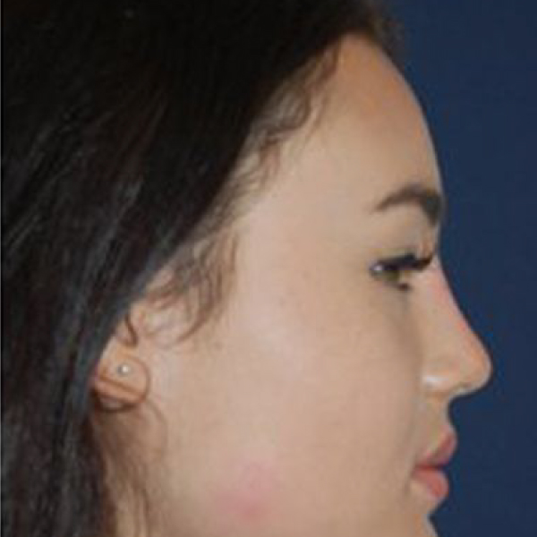 NonSurgical Nose Job in London from £650 111 Harley St.