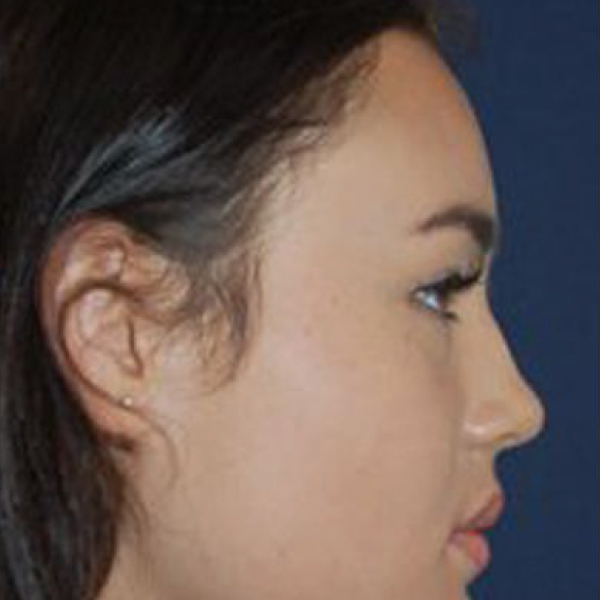 NonSurgical Nose Job in London from £650 111 Harley St.