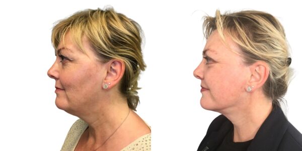 before and after lip lift