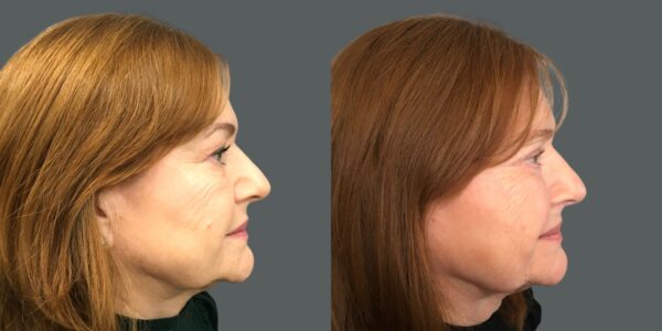 before and after eye lid surgery