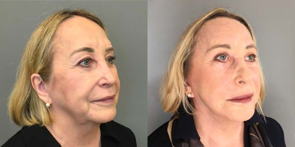 A Deep Plane Facelift Before and After Photo