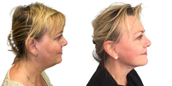 before and after lip lift