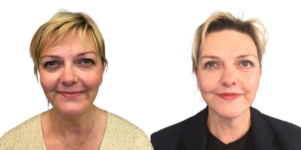 before and after lip lift front