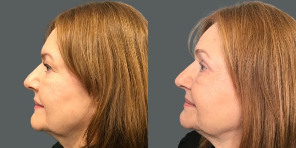 before and after eye lid surgery side