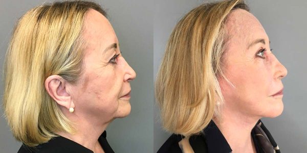 A Deep Plane Facelift Before and After Photo