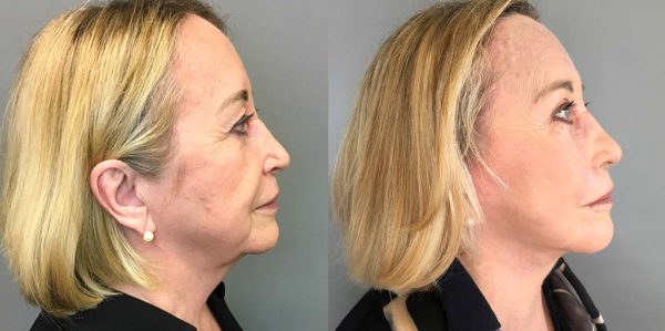 A Deep Plane Facelift Before and After Photo