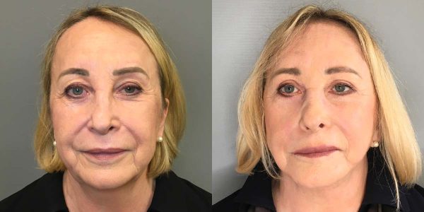 A Deep Plane Facelift Before and After Photo