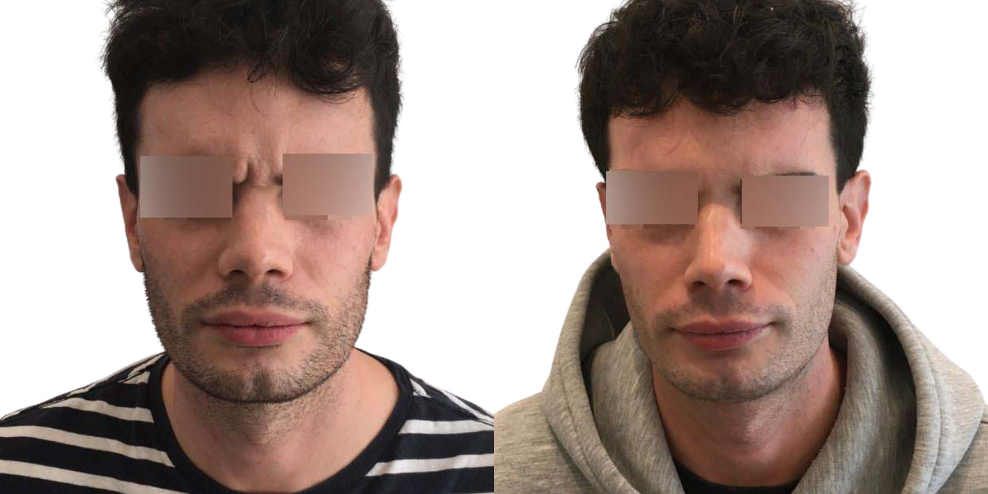 Botox London - Anti Wrinkle Injections & Treatments in Harley St.
