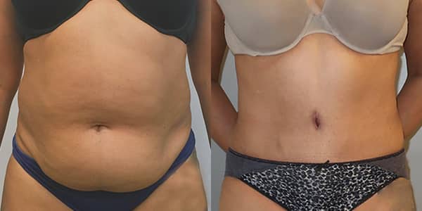 Tummy Tuck London