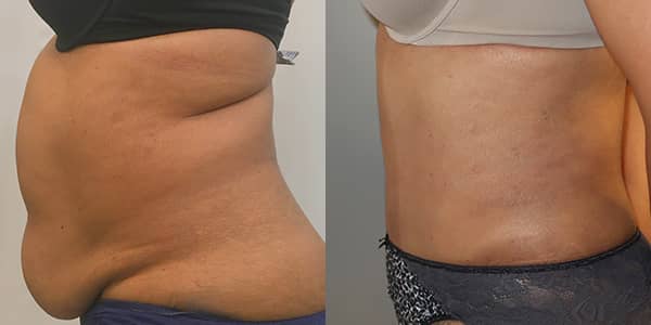 Tummy Tuck London