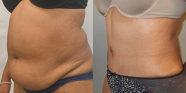 Tummy Tuck London