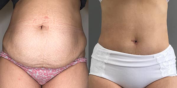 Tummy Tuck London