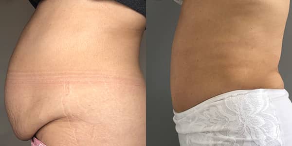 Tummy Tuck London