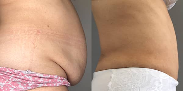 Tummy Tuck London