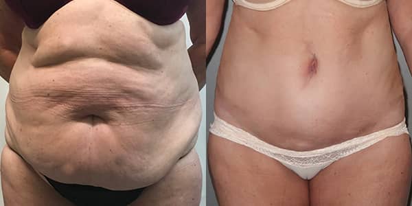 Tummy Tuck London