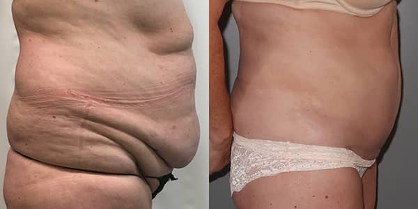 Tummy Tuck London