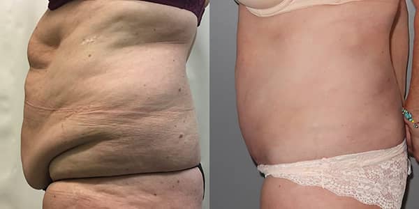 Tummy Tuck London