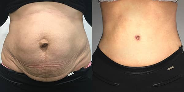 Tummy Tuck London