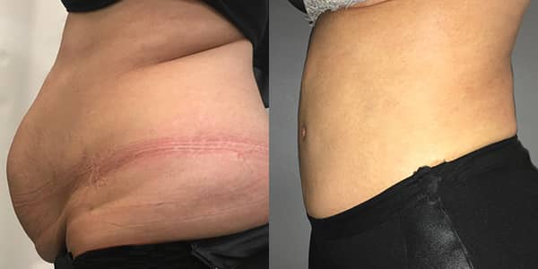 Tummy Tuck London