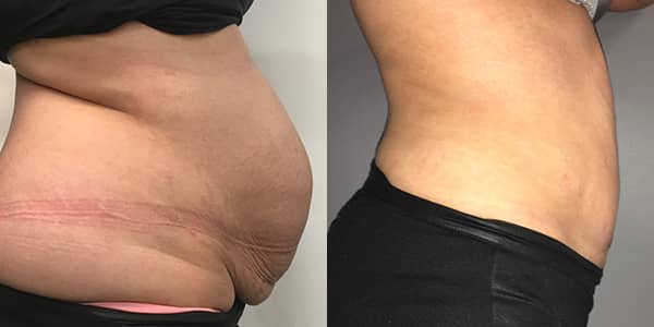 Tummy Tuck London